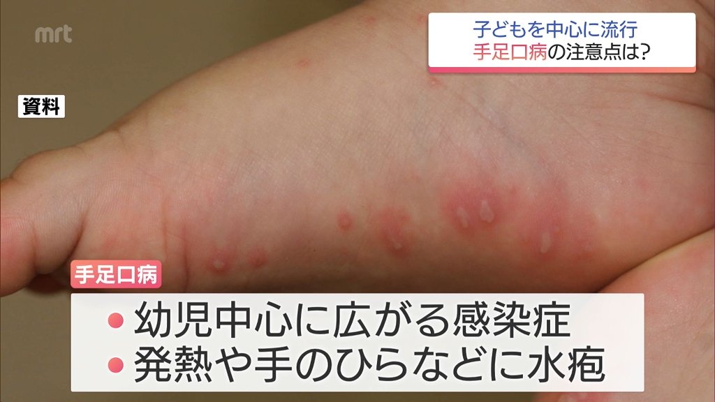 「手足口病」 宮崎県内で流行警報レベル超　小児科医に注意点を聞く（MRT宮崎放送） - Yahoo!ニュース