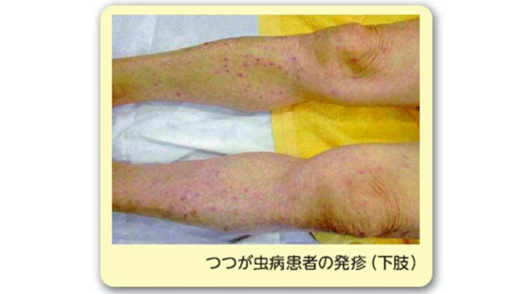 今年度初の「つつが虫病」40代男性が頭痛や発熱などの症状 治療が遅れると命に関わる場合も（山形）