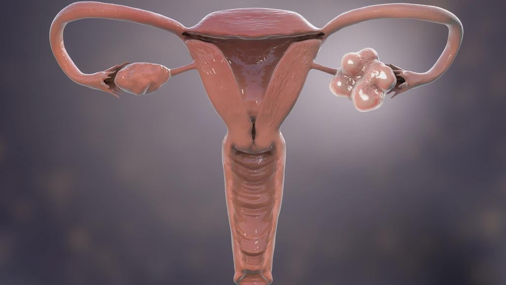 何百万人もの女性が罹患しているホルモン障害に新しい名前が付けられる