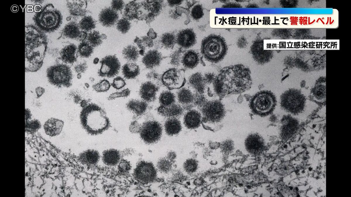 水ぼうそう患者数が警報レベル 山形県の村山と最上の保健所管内で